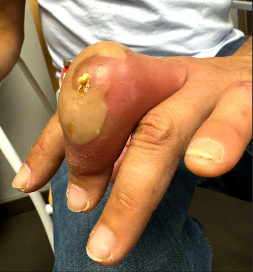 Purulent discharge visible on fingertip