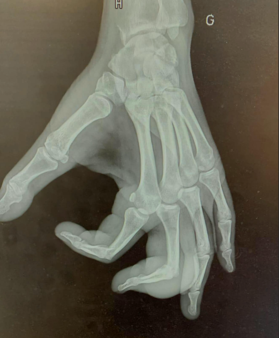 Radiograph showing soft tissue swelling